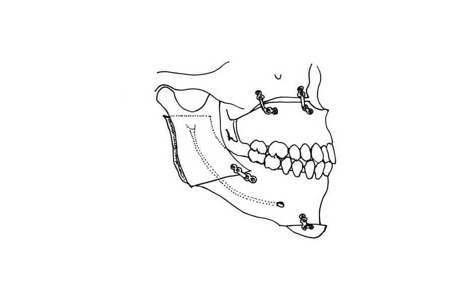 顎矯正手術のイメージ